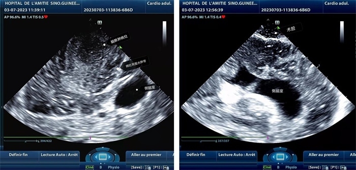 左圖顯示術(shù)中超聲見(jiàn)囊實(shí)性病變，大小約為4x4x3cm，病灶周?chē)X組織水腫明顯；右圖為病灶切除后，術(shù)中超聲示術(shù)腔無(wú)病變殘留