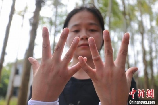 吳素英展示被蜜蜂蜇過的雙手。湯曉逵 攝