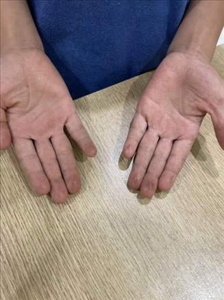 9歲小學(xué)生長期拍煙卡，手部粗糙長繭。受訪者供圖